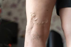 varicose veins on a leg