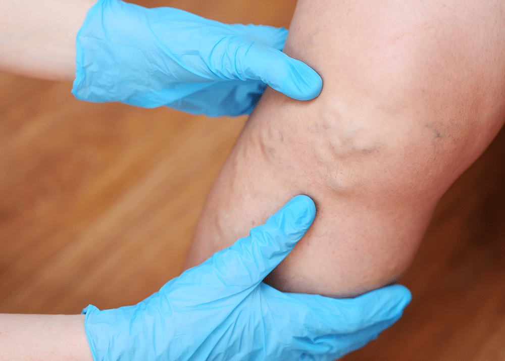 doctor examining a leg with varicose veins