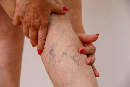leg with spider veins and varicose veins