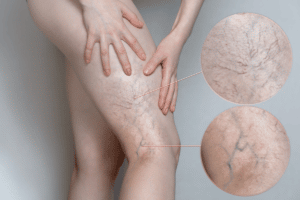 woman with varicose veins on leg