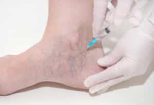 foot with spider veins