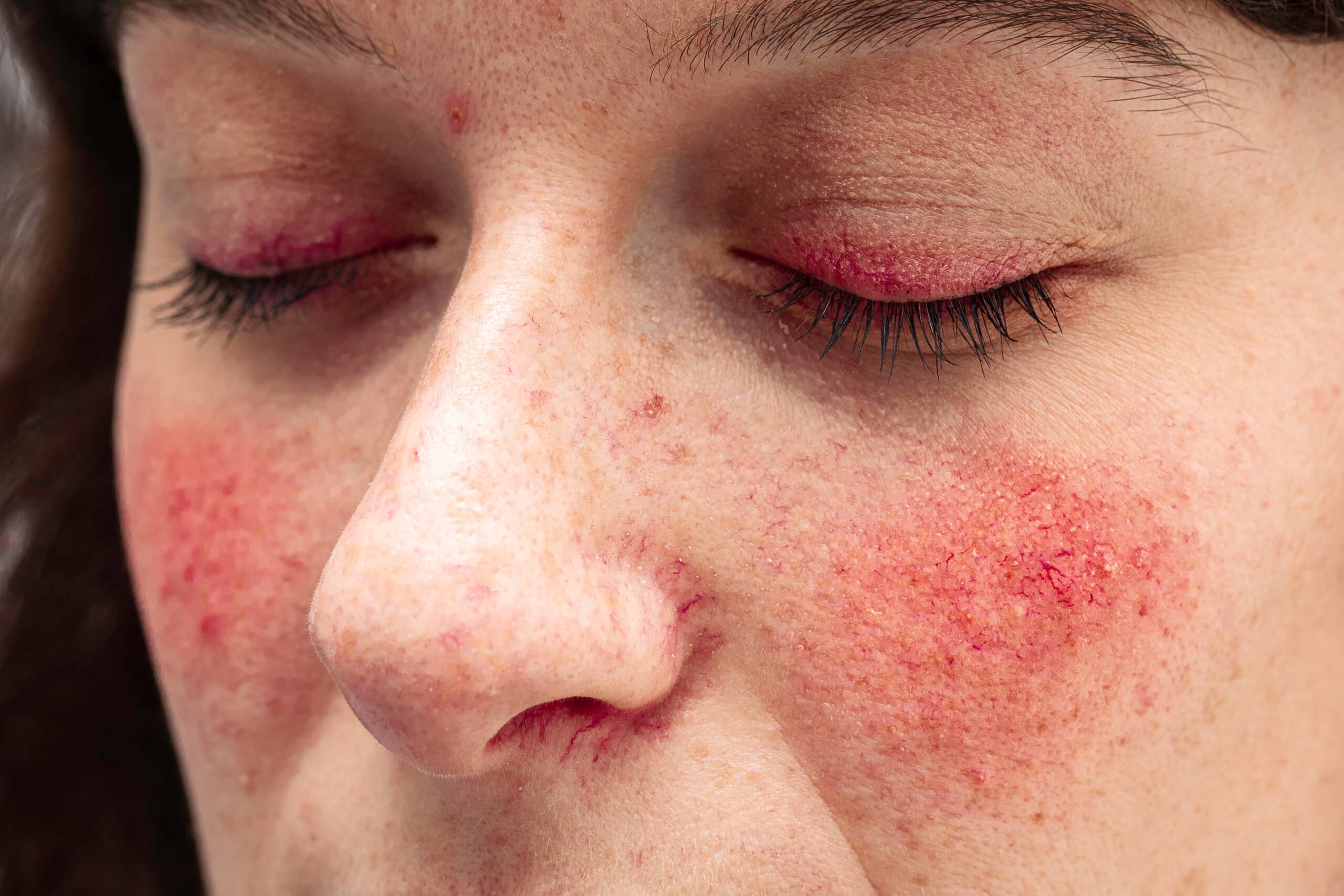 close view of woman's cheeks with redness