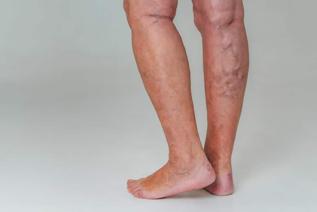 varicose veins on legs