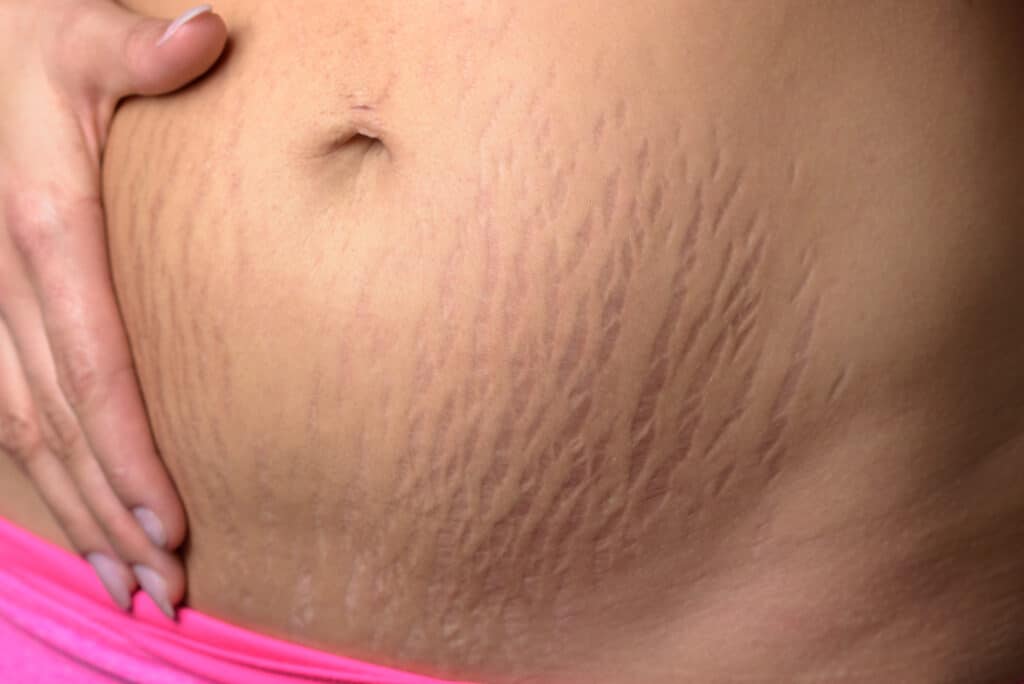 Raised Blood Vessels on Stretch Marks